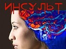 Инсульт